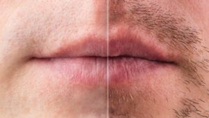 Mustache Transplant