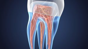 Endodontie (Wurzelkanalbehandlung)