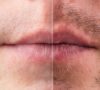 Trasplante De Bigote